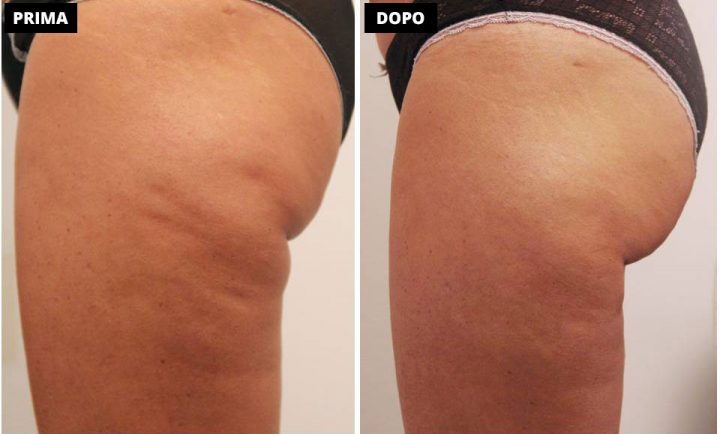 Pressoterapia prima e dopo risultati centro estetico fiore di loto